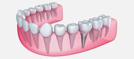 Dental implant in the gum - Isolated on white